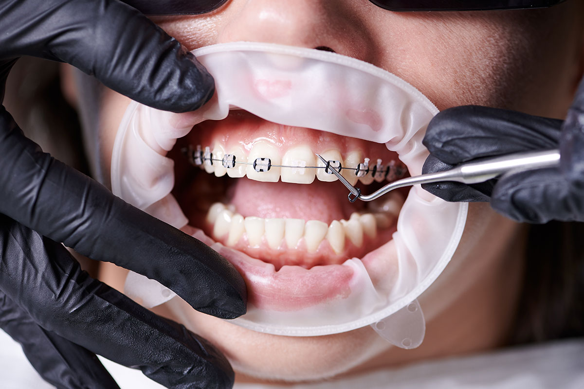 aparate-dentare-1