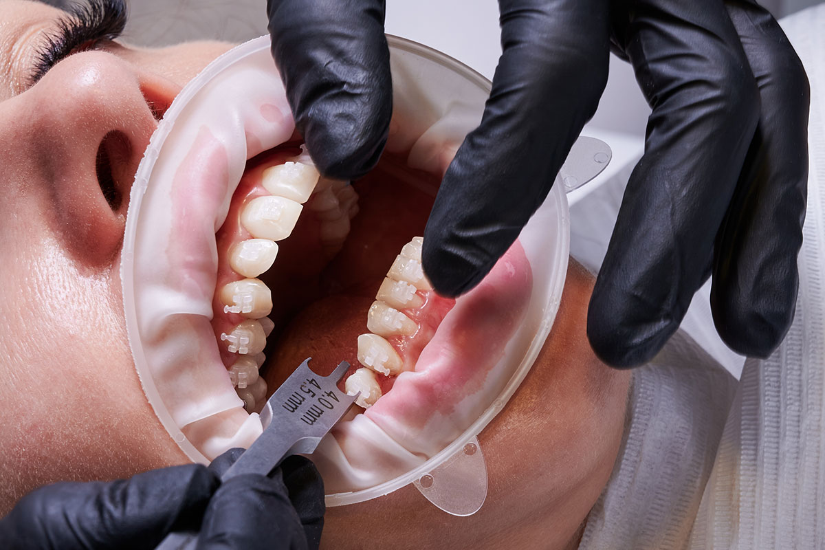 aparate-dentare-2