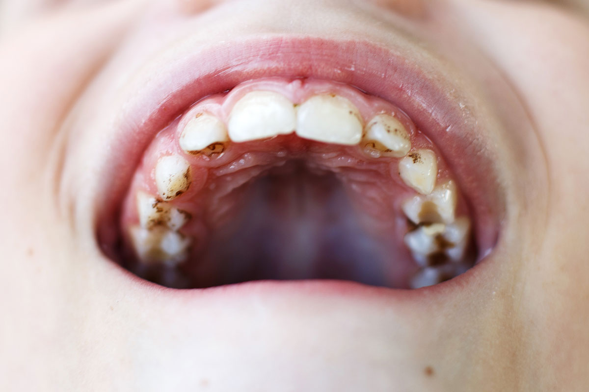 carii-dentare-copii