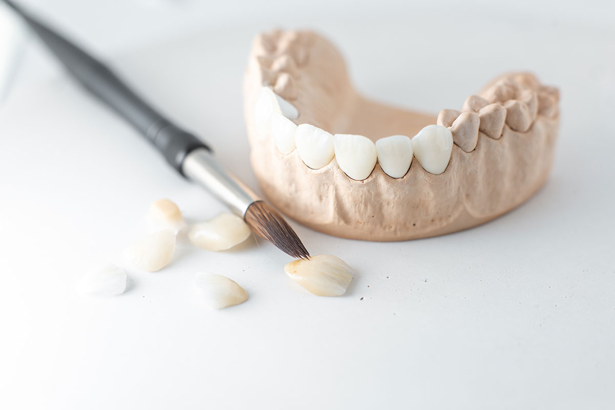 coroane-dentare-1