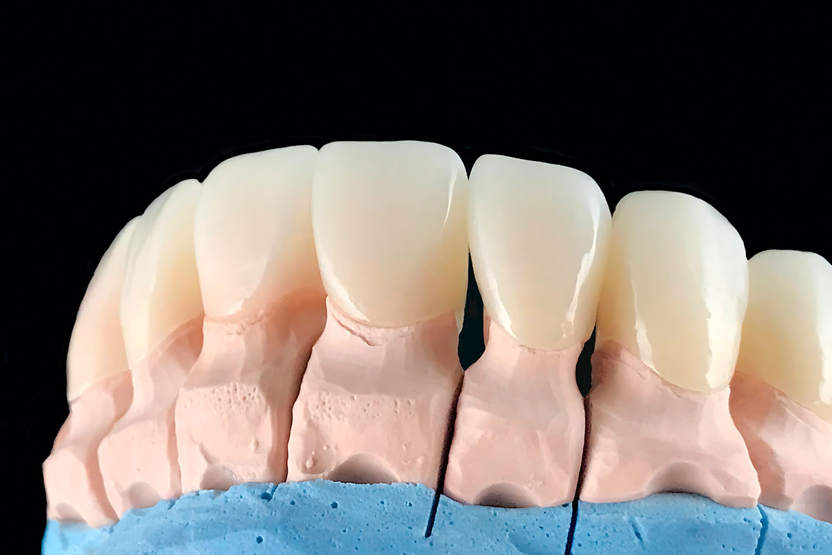 coroane-dentare-2