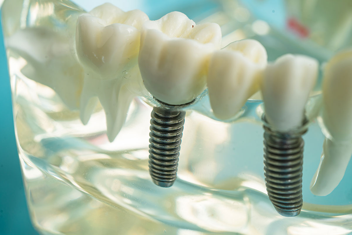 implant-clasic